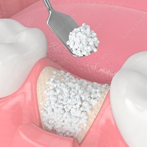 Chirurgie pré-implantaire (sinus lift et greffes osseuses)
