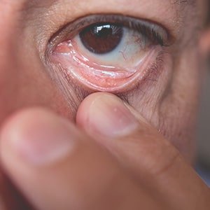Autres chirurgie des machoires : entropion, ectropion, voies lacrymales bouchées à Carcassonne
