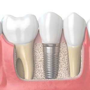 Les implants dentaires à Carcassonne